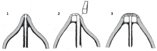Схема ринопластики при коррекции внутреннего носового клапана, сайт пластического хирурга Аганесова Г. А.
