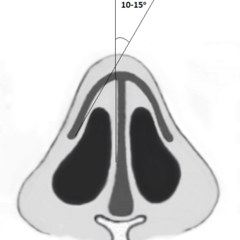 Клапанный угол наружного клапана носа в норме составляет от 10 до 15 градусов.