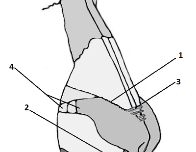 Структуры, удерживающие крылья носа в стабильном положении. Сайт пластического хирурга Г. Аганесова